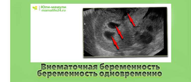 Флюорография на ранних сроках беременности — можно ли делать, влияние и последствия
