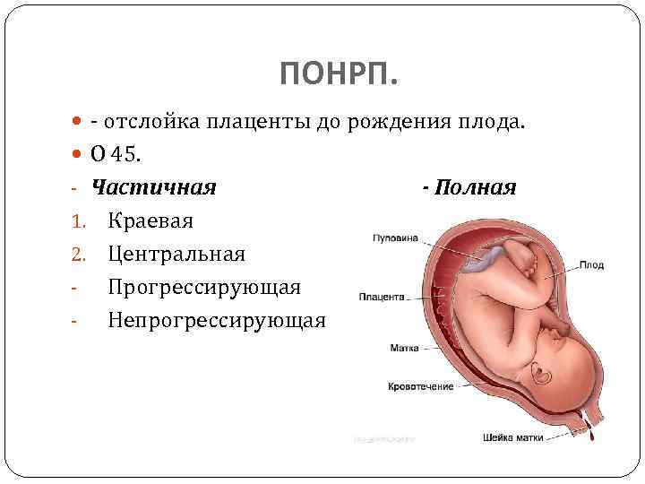 Отслойка плаценты на ранних и поздних сроках беременности - симптомы, последствия