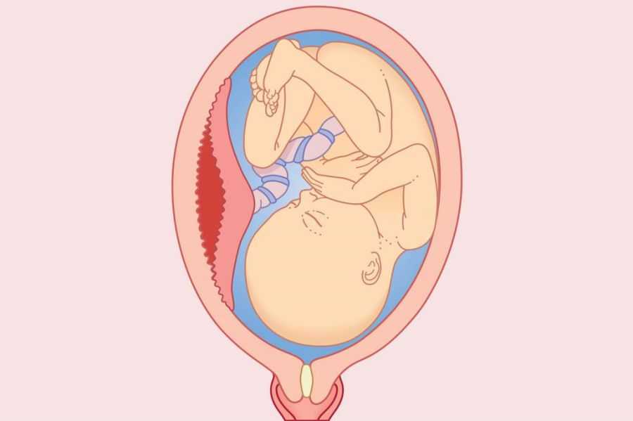Отслойка плаценты на поздних сроках беременности: причины, признаки, последствия