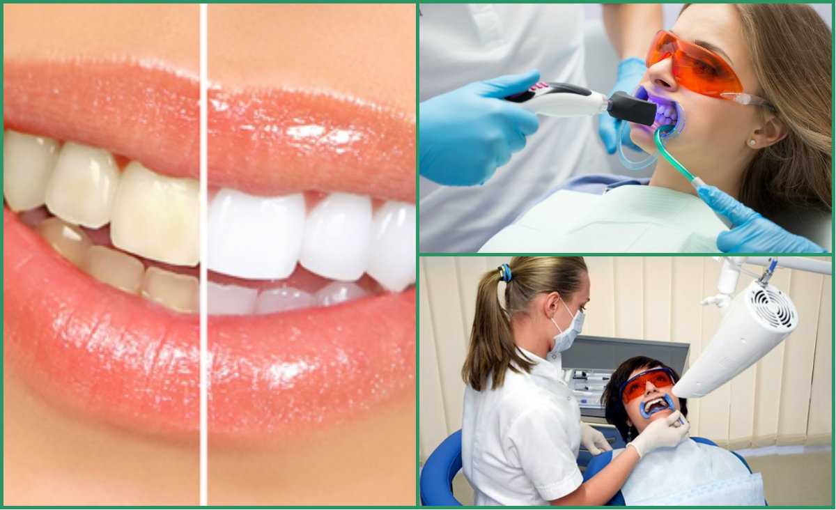 все про отбеливание зубов в стоматологии