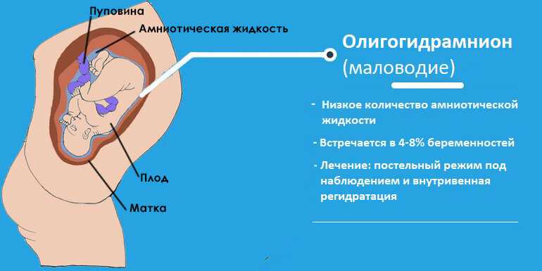 Подтекание вод при беременности. признаки подтекания околоплодных вод при беременности :: syl.ru