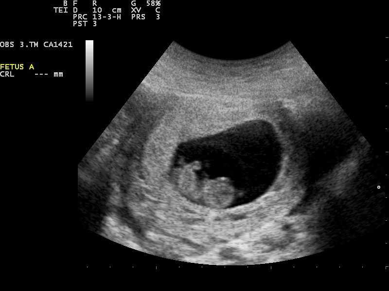 На каком сроке узи показывает беременность (21 фото): когда можно определить и видна беременность, на какой неделе на ранних сроках покажет беременность после зачатия
