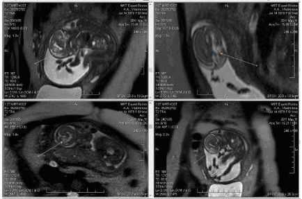 Магнитно-резонансная томография при беременности: возможный вред