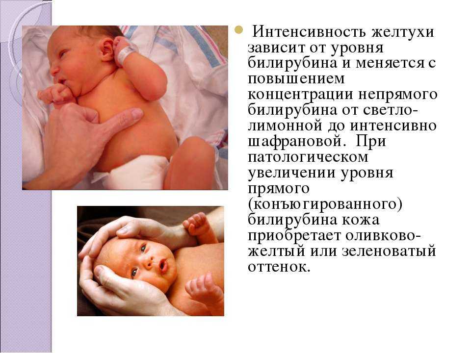 Конъюгационная желтуха у новорожденных: причины, симптомы, лечение и последствия