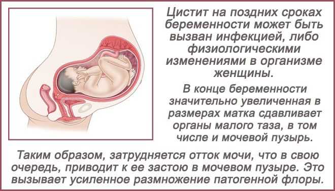 Цистит при беременности: симптомы, лечение на ранних сроках