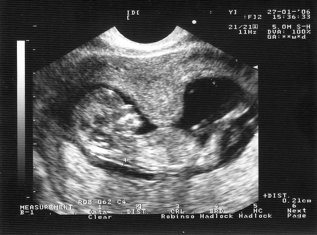 Гипертонус матки при беременности: что это такое, причины, признаки и лечение