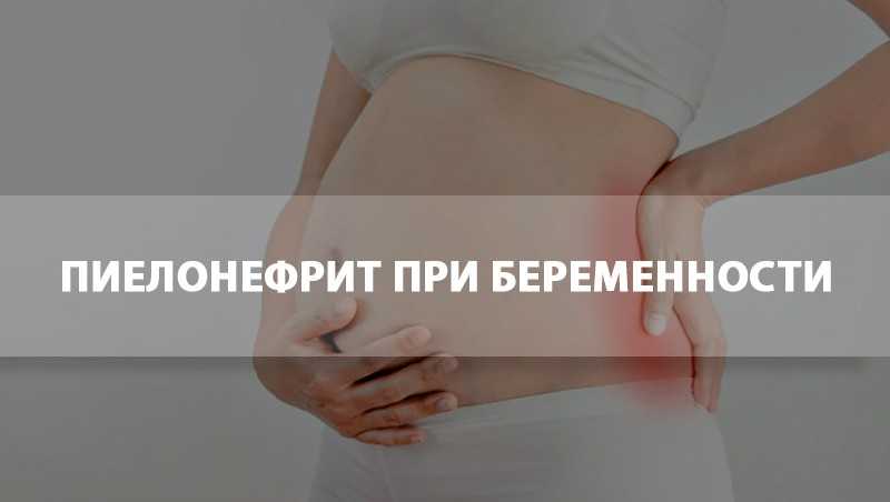 Пиелонефрит беременных (гестационный пиелонефрит) - наблюдение беременности.  здоровье