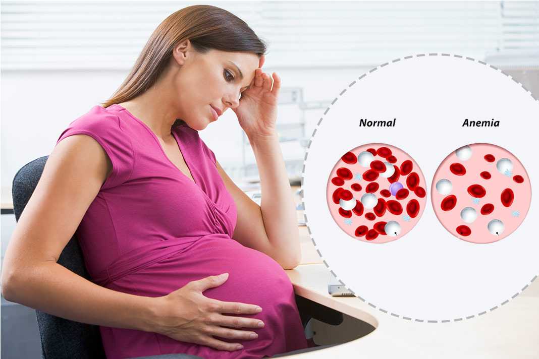 Какие существуют симптомы степени и виды анемии при беременности Причины и последствия анемии при беременности способы коррекции и лечения малокровия