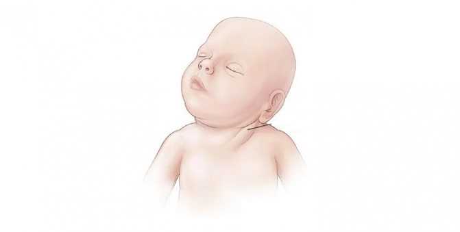 Признаки и симптомы кривошеи у новорожденных и грудничков