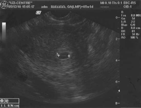 Первый месяц беременности (19 фото): симптомы и ощущения, ключевые признаки и рекомендации, что происходит с эмбрионом, алкоголь и секс, виден ли живот