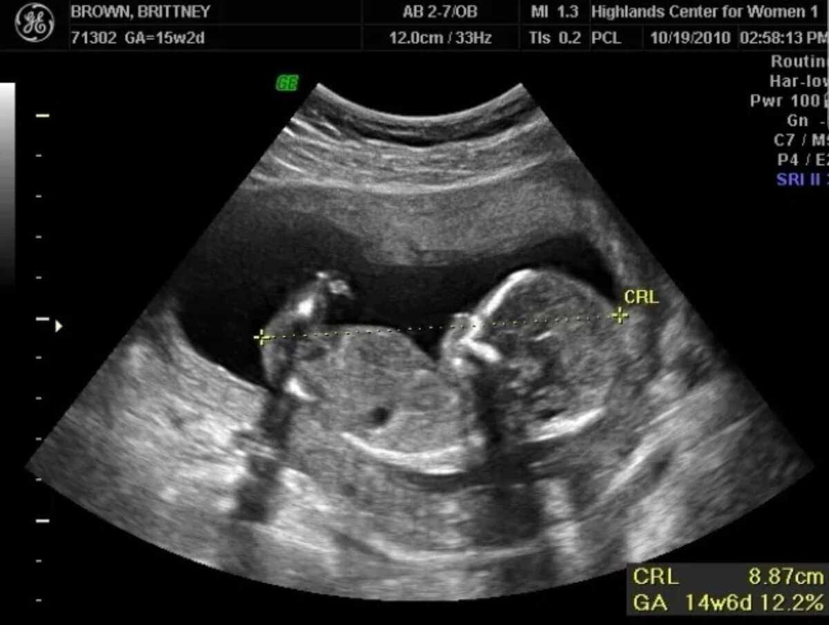 14 недель беременности (29 фото): что происходит с малышом и мамой, размер плода и пол ребенка, развитие и как выглядит ребенок на 13-14 акушерской неделе, рост и его вес