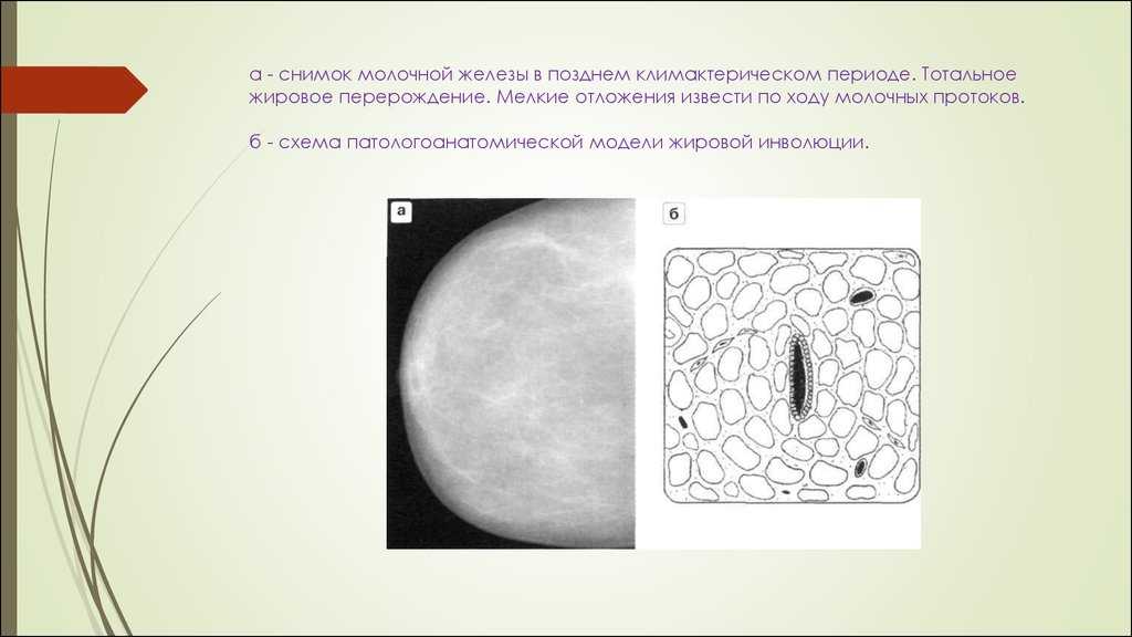 Молочные железы жировые. Жировое Перерождение молочной железы. Инволюция молочной железы. Жировая инволюция молочных желез что это такое. Типы жировой инволюции молочной железы.