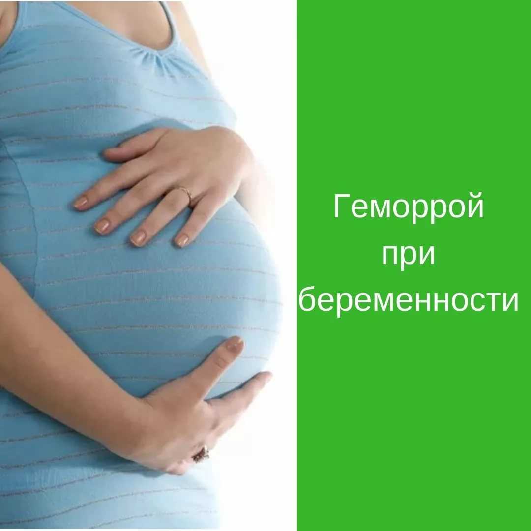 Лечение геморроя во время беременности