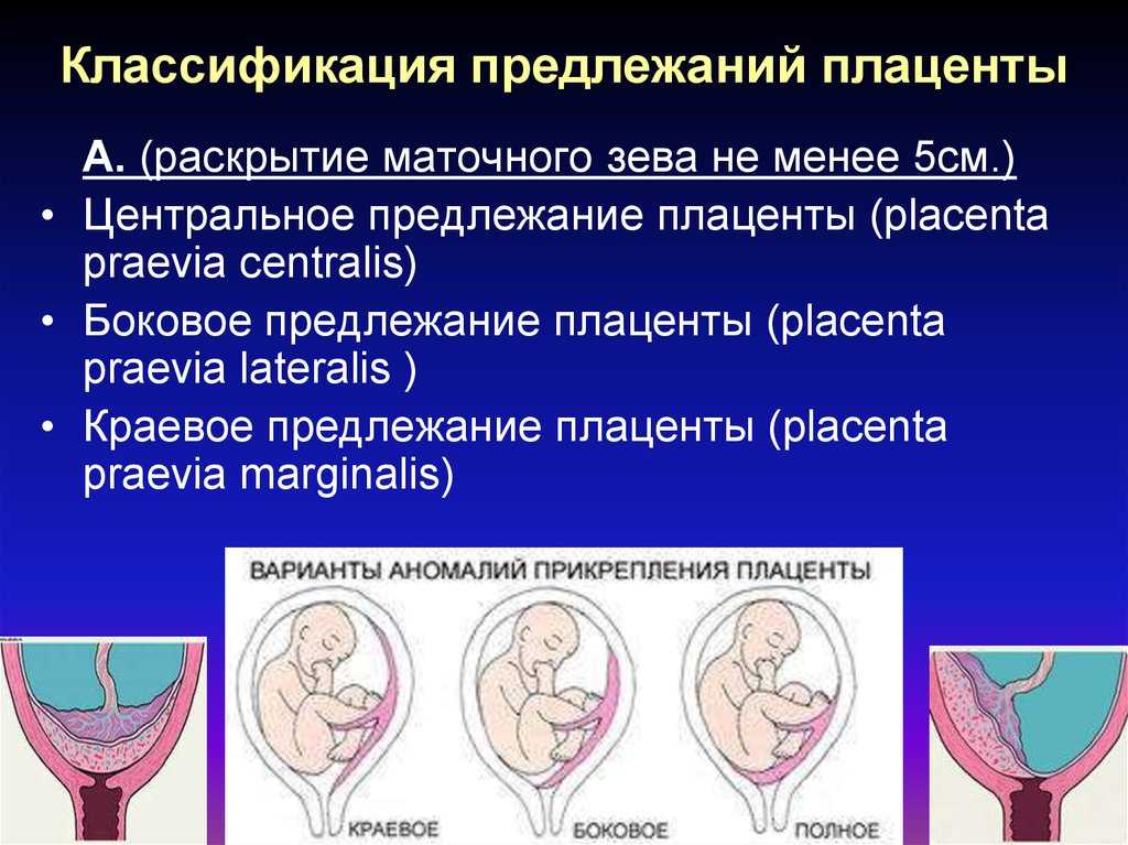 Низкая плацентация при беременности: причины, симптомы, прогноз родов