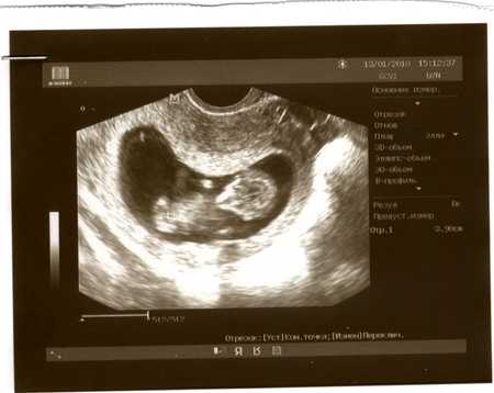 Гипертонус матки при беременности 2 триместр (во втором триместре)