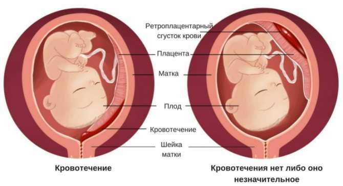 Отслойка плаценты: промедление недопустимо! причины отслойки плаценты на ранних сроках беременности