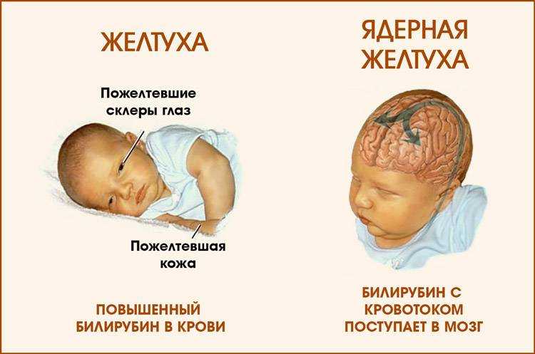 Желтуха у новорожденного – часто встречающееся явление Это состояние может быть нормой или признаком тяжелого заболевания Каковы симптомы и лечение желтухи